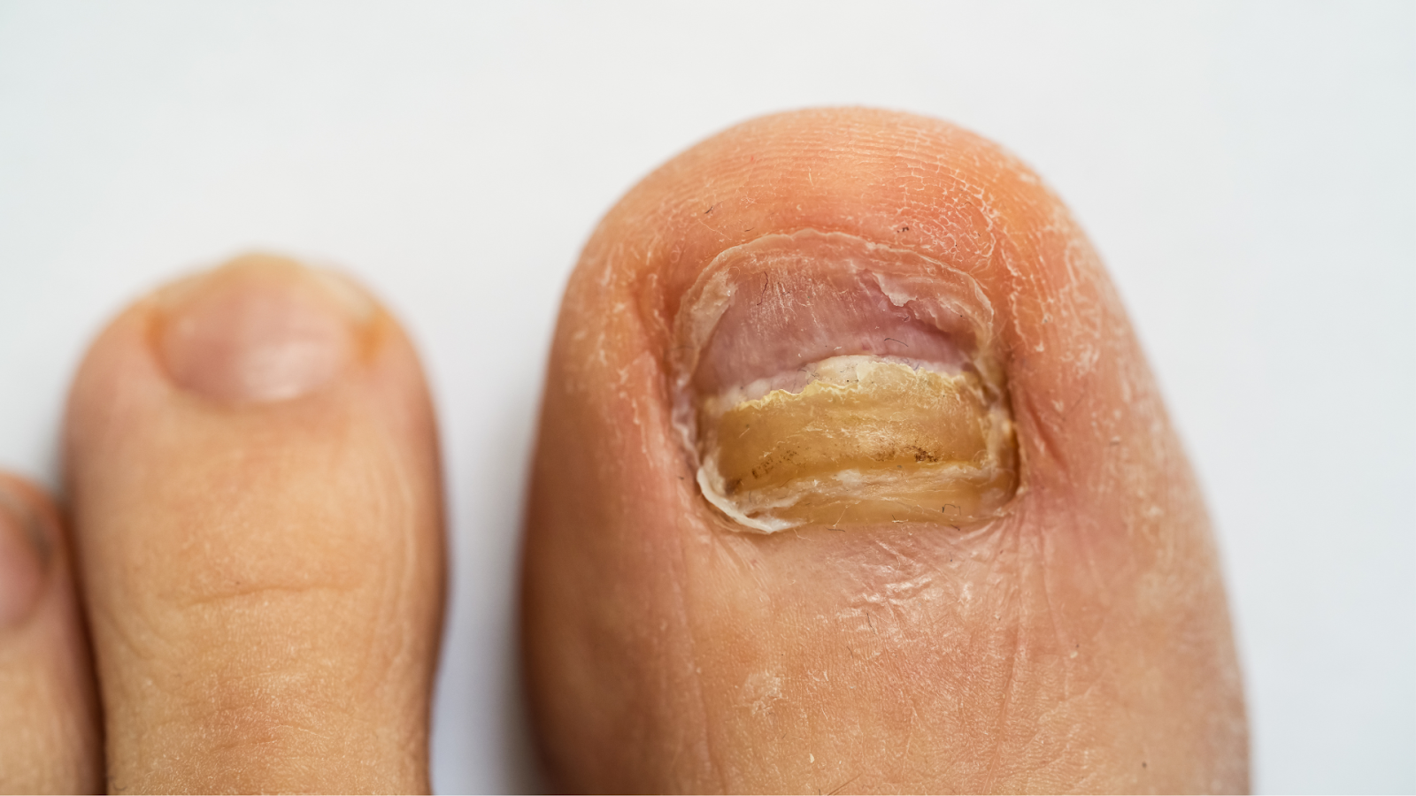 Close-up of a toenail with fungal infection and thickened nail plate, a common foot condition among runners in Singapore if foot hygiene is neglected.