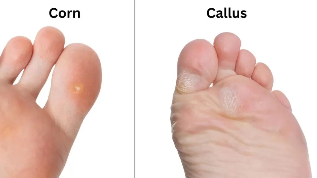 Close-up comparison of a corn and a callus on toes, highlighting why professional corn removal treatment in Singapore is needed.