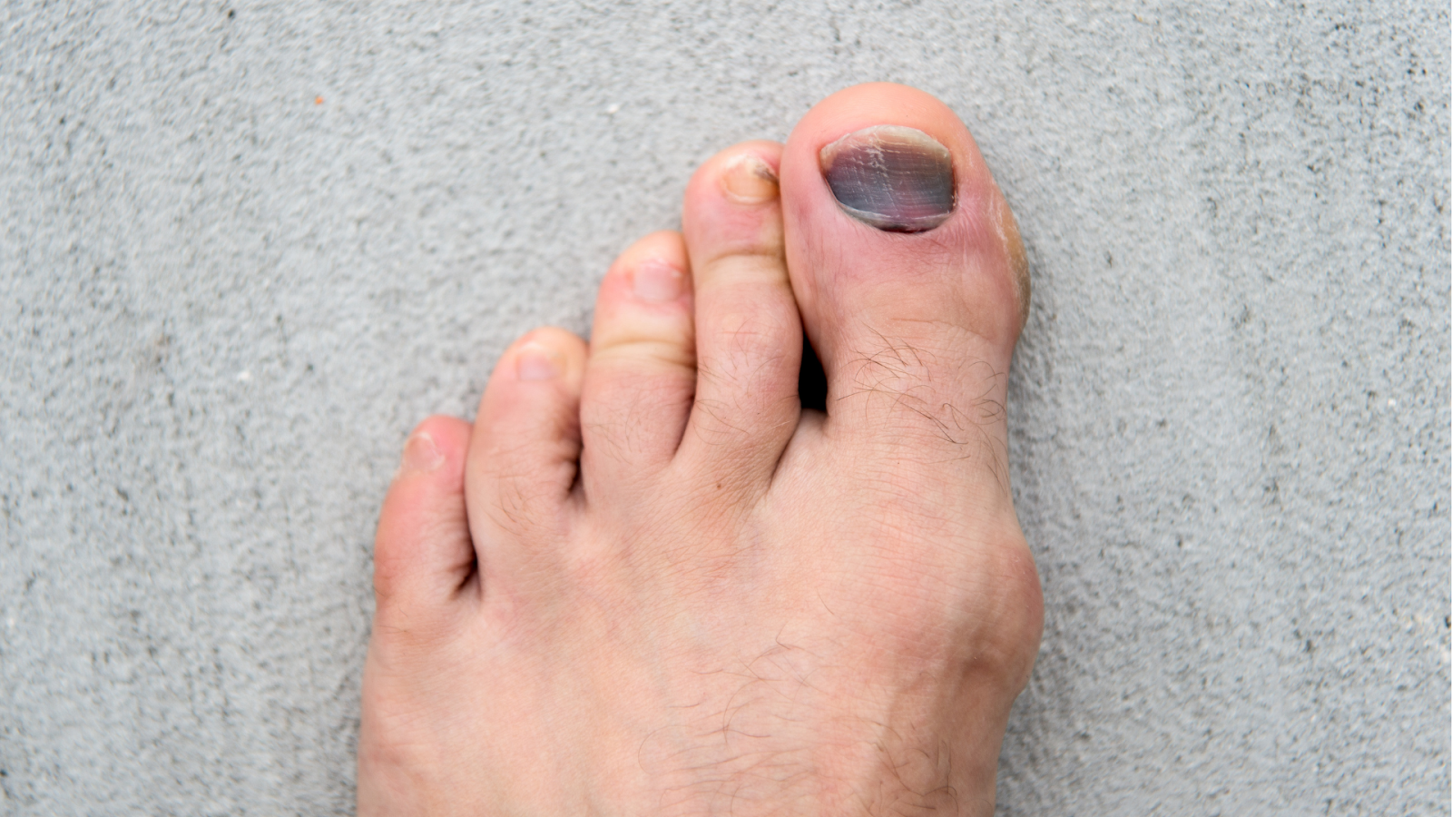 Close-up of a foot with a black toenail, a common running injury caused by repetitive trauma — often seen in marathon runners in Singapore.