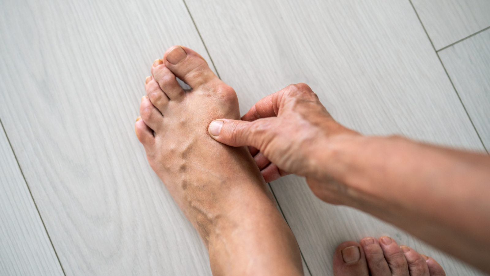 Bunion deformity causing foot pain in Singapore.