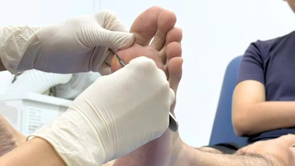Podiatrist performing safe and professional corn removal treatment in Singapore using specialised tools.