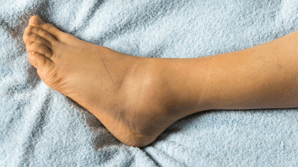 Close-up of a swollen foot and ankle lying on a towel, showing symptoms of plantar fasciitis or related conditions.