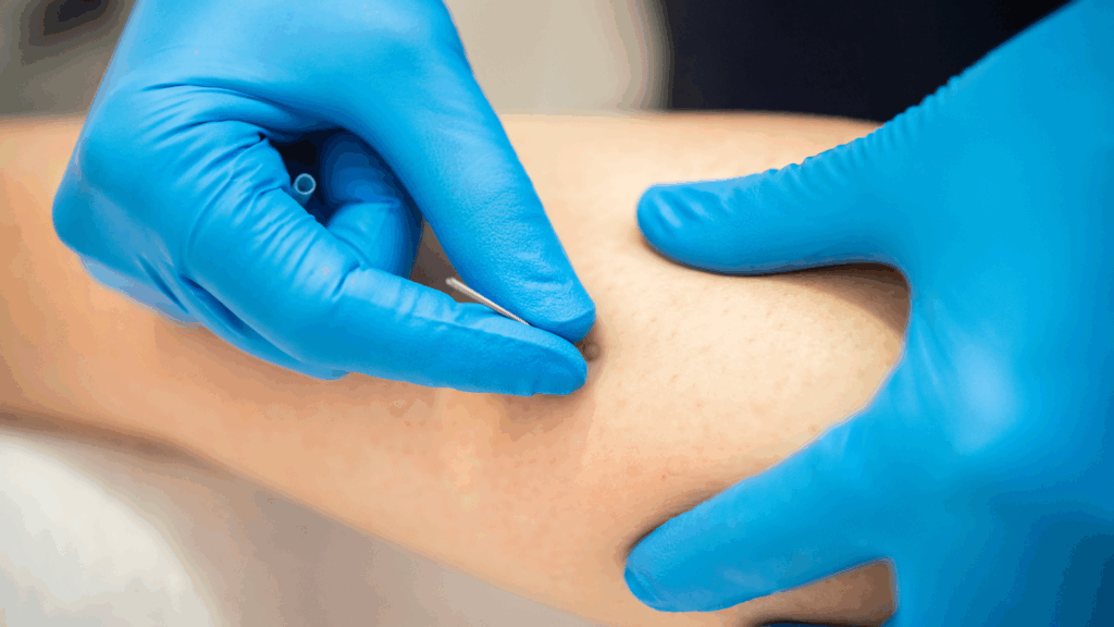 Gloved physiotherapist inserting a dry needle into a muscle trigger point, showcasing dry needling treatment for chronic muscle tightness.