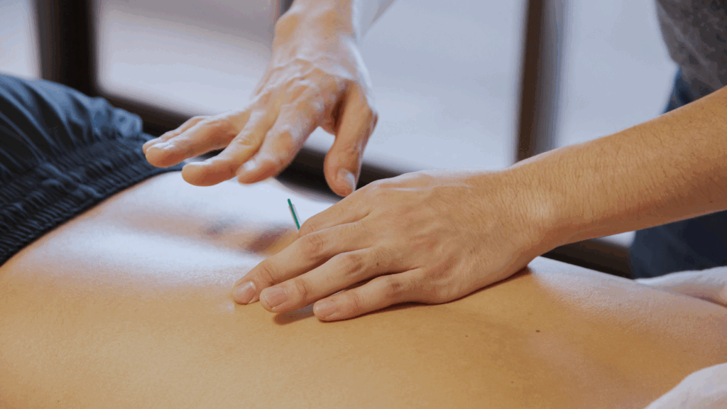 Physiotherapist performing dry needling on a patient’s lower back, commonly used to relieve deep muscle knots and pain in the lumbar region.
