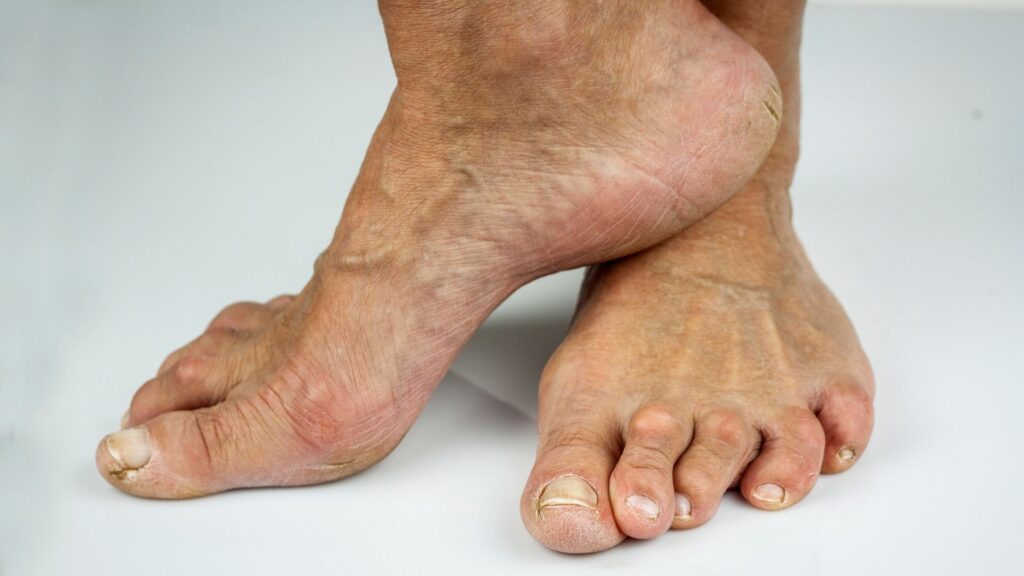 Elderly person with swollen ankles from arthritis showing how orthotics can reduce joint stress