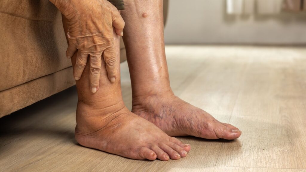 Close-up of swollen diabetic feet showing how orthotics can help reduce pressure points and protect against ulcers