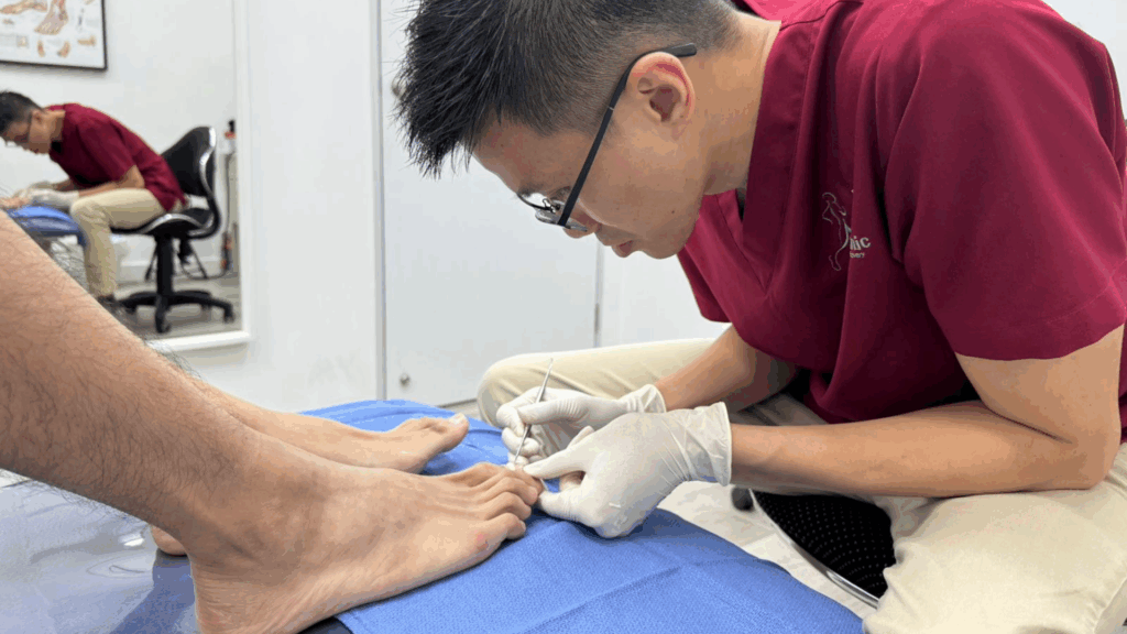 A podiatrist carefully treating a patient’s toenail at Physio & Sole Clinic Singapore, providing expert podiatry care for ingrown and nail conditions.