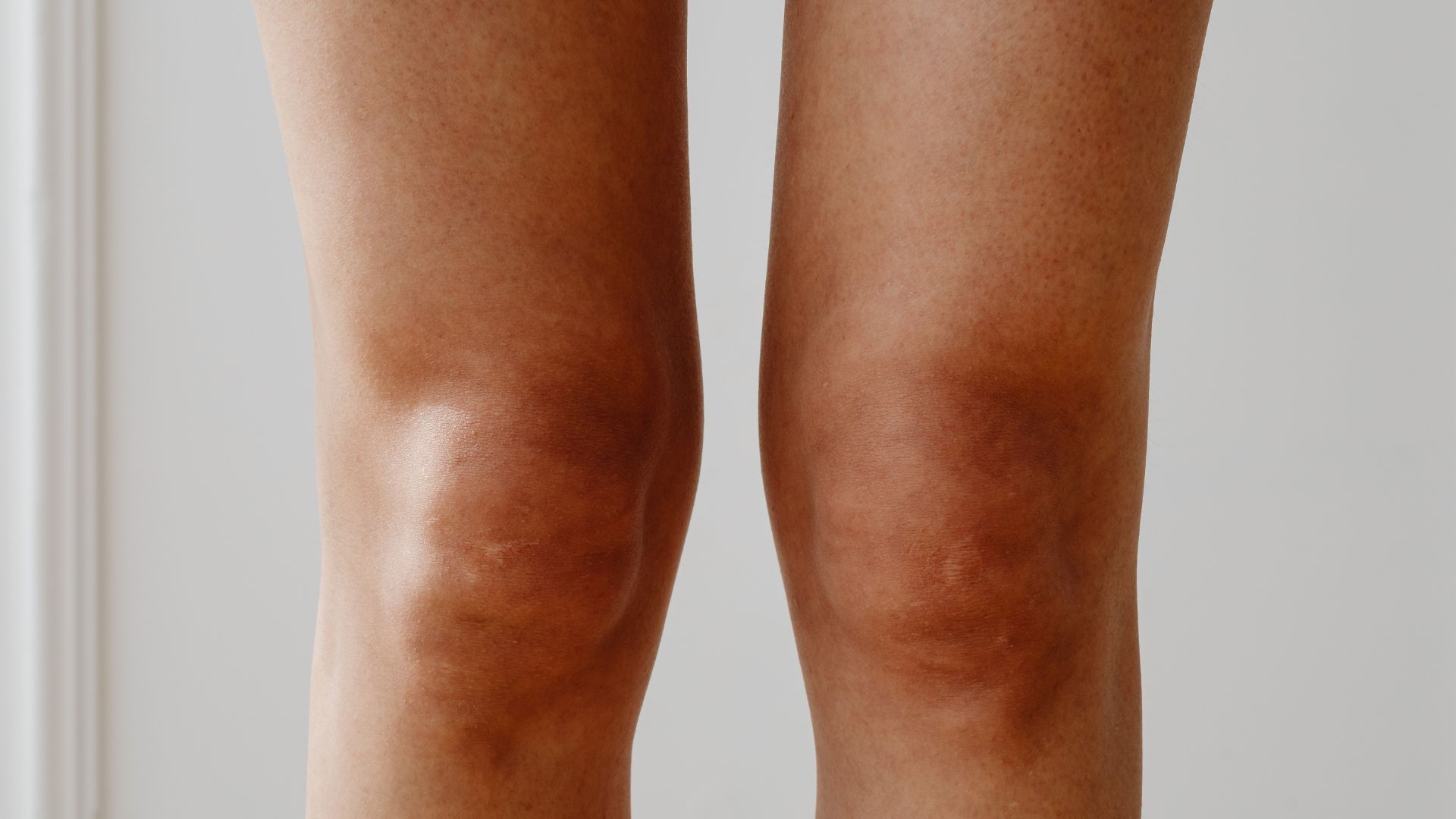 Close-up of a person's knees showing natural leg alignment.