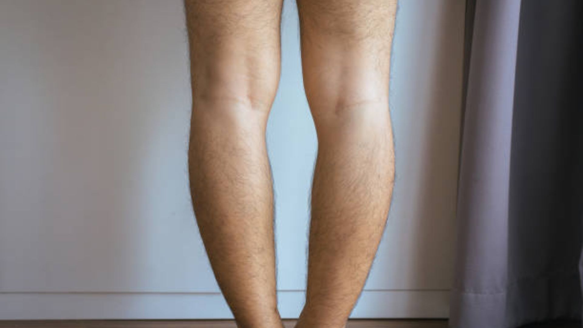 Back view of an adult standing with legs showing visible bow-legged alignment.