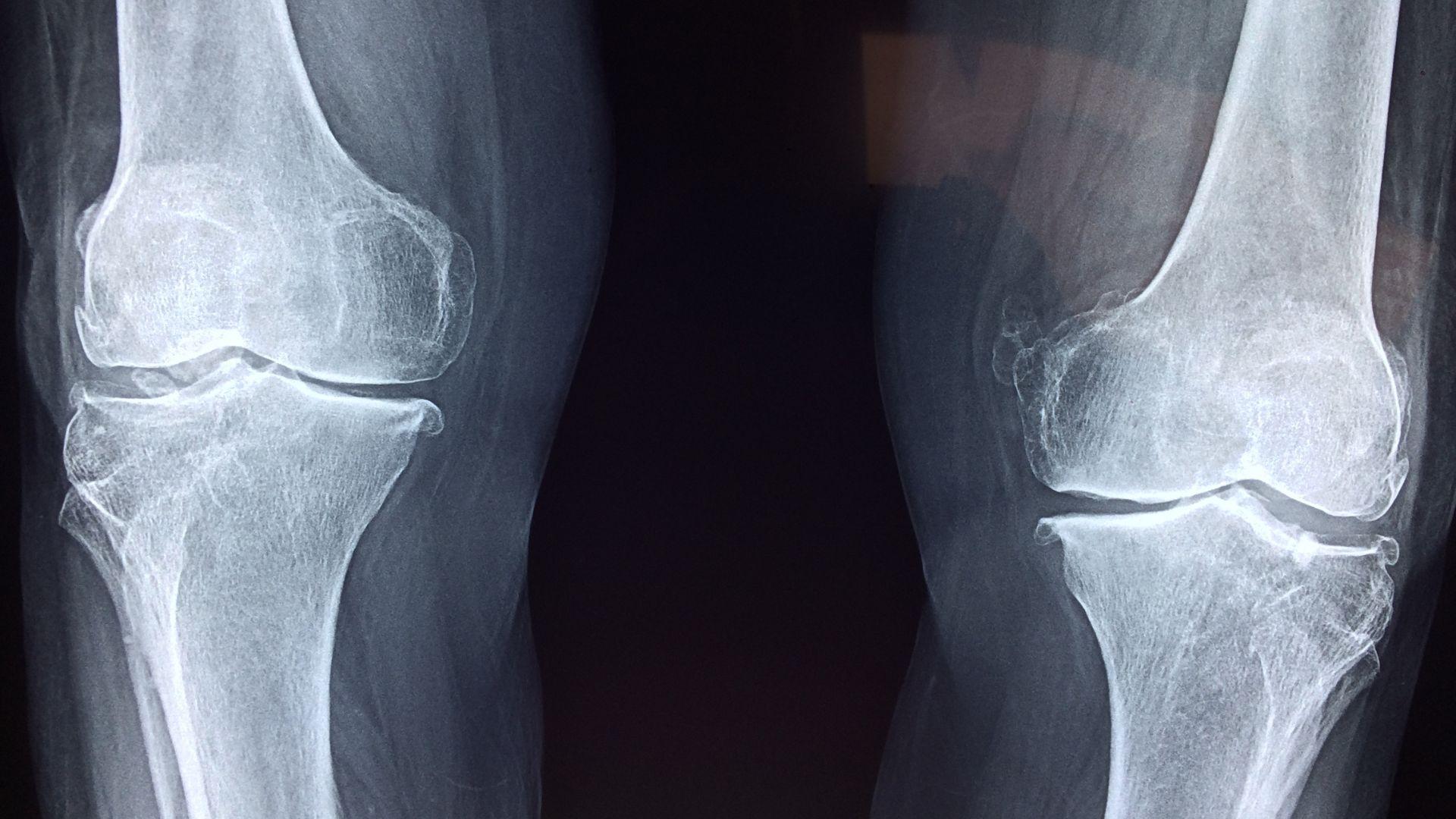 X-ray image of knee joints showing leg alignment and bone structure.