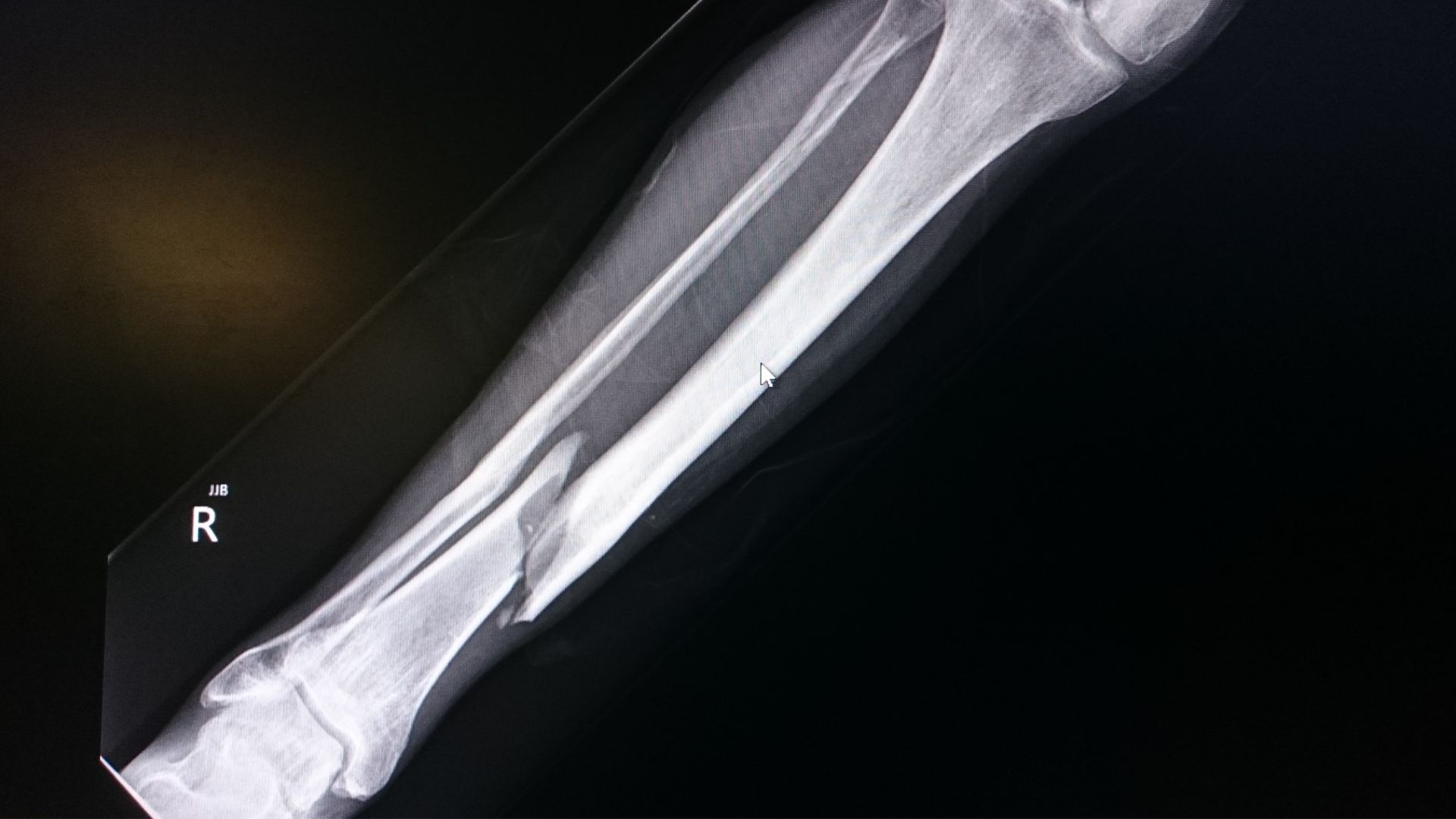 X-ray of the lower right leg showing the tibia and fibula for structural evaluation.