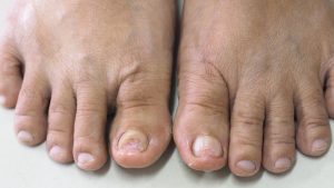 Infected toenails on elderly feet showing thickening and nail damage from fungal infection