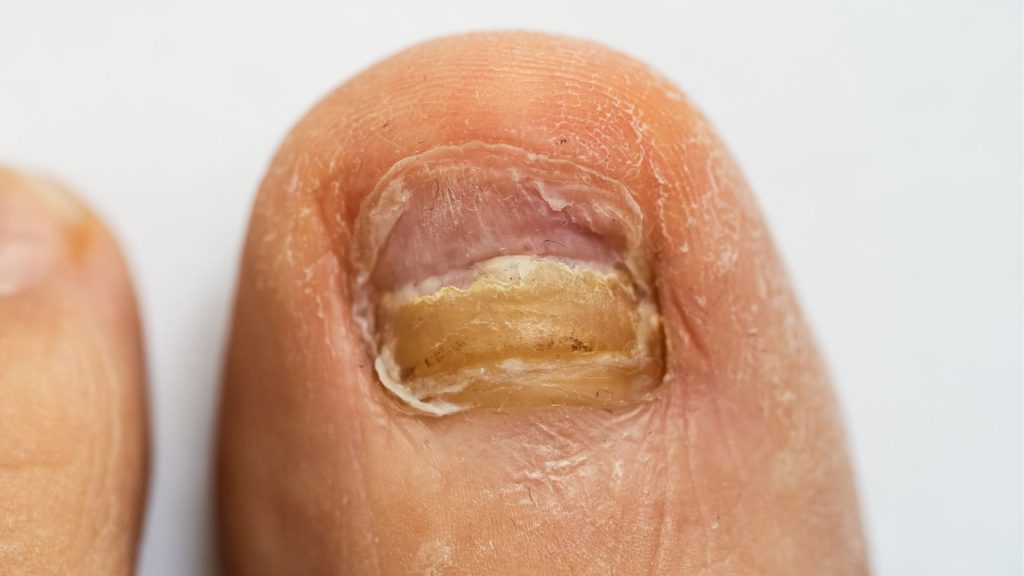 Close-up of toenail infection with thickened nail and discolouration in an elderly patient