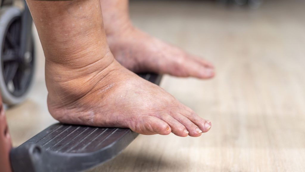 Elderly foot stepping onto mobility aid, showing how foot problems can affect balance and movement