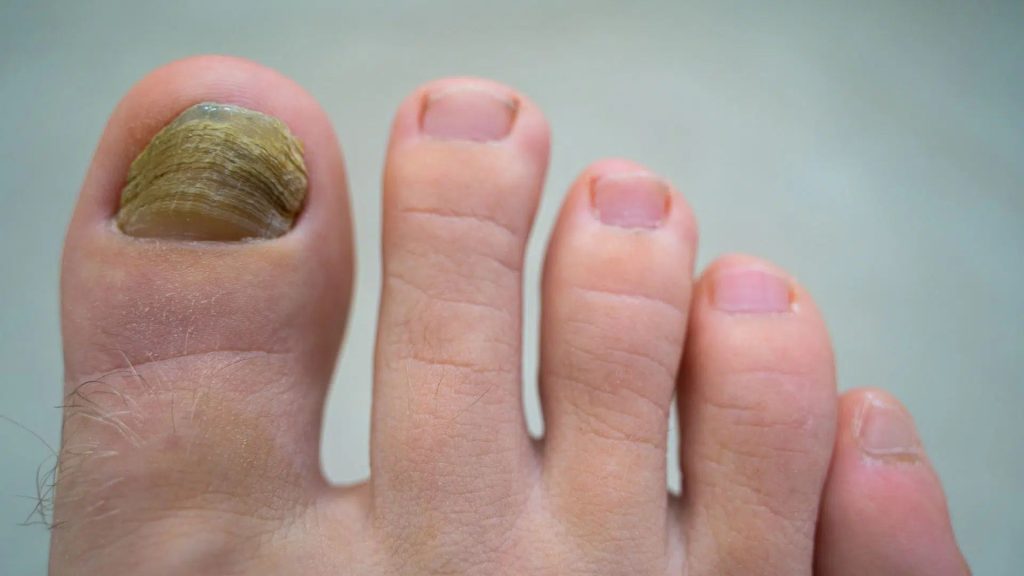 Thickened, yellow-brown toenail showing fungal nail infection commonly seen in elderly patients