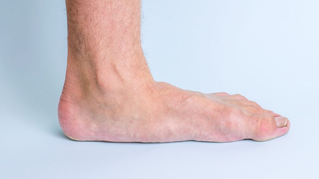 Side view of a flat foot showing reduced arch, a common foot posture issue