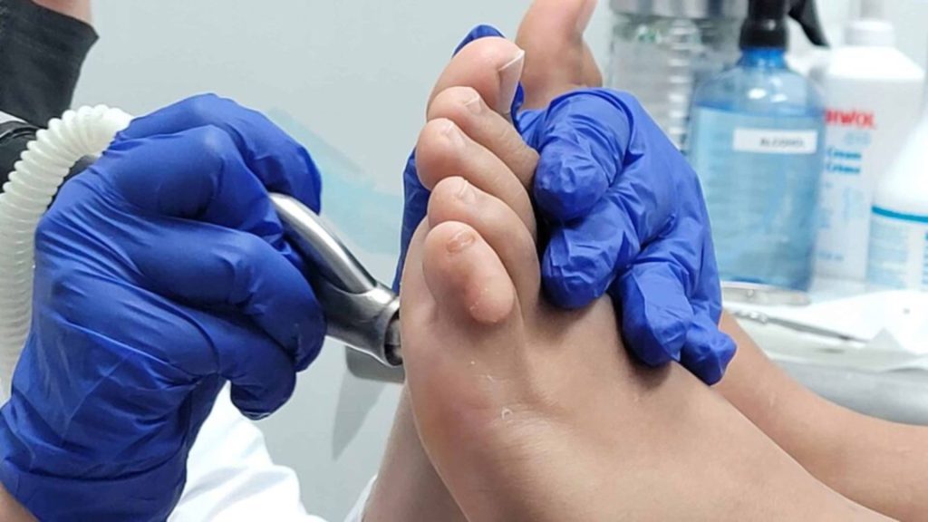 Podiatrist performing medical pedicure care, safely removing callused skin using sterile instruments