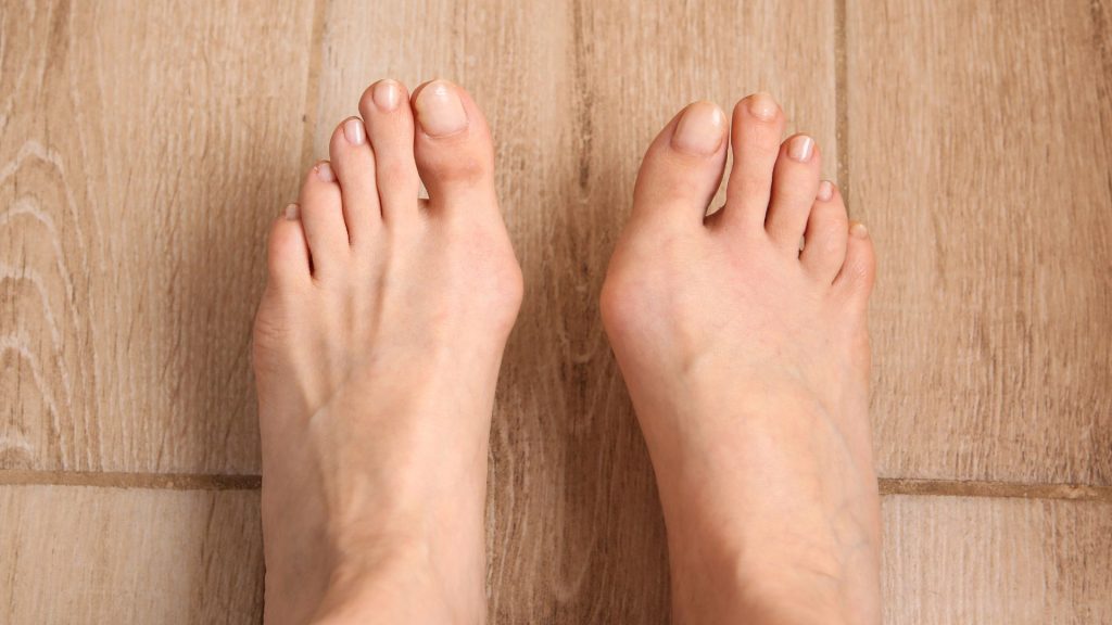 Foot bunion condition causing pain that may require podiatry treatment in Yishun