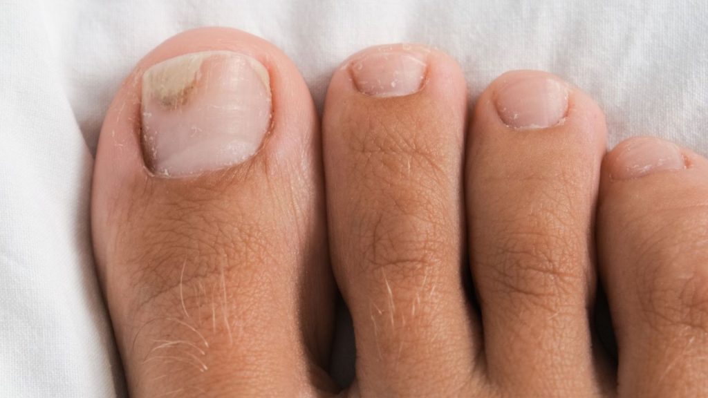 Toenail with discolouration and thickening, commonly seen in fungal nail infections
