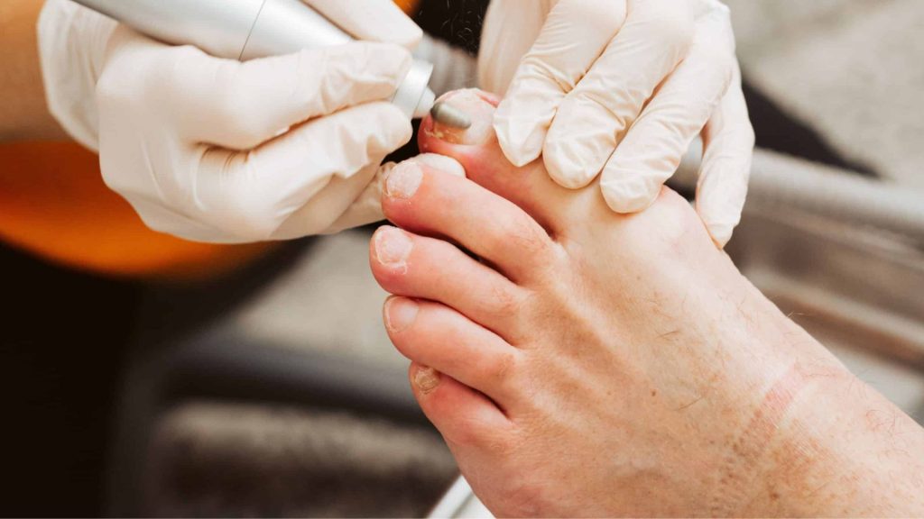 Medical pedicure treatment showing a podiatrist thinning a thickened toenail with sterile equipment
