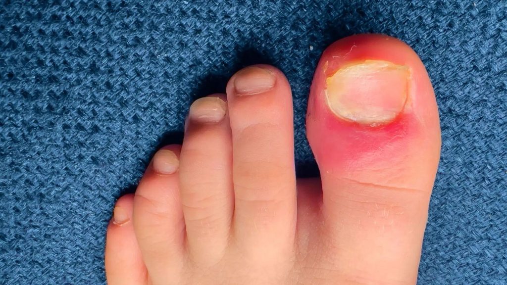 Toe showing redness and swelling around the nail area that may require professional assessment