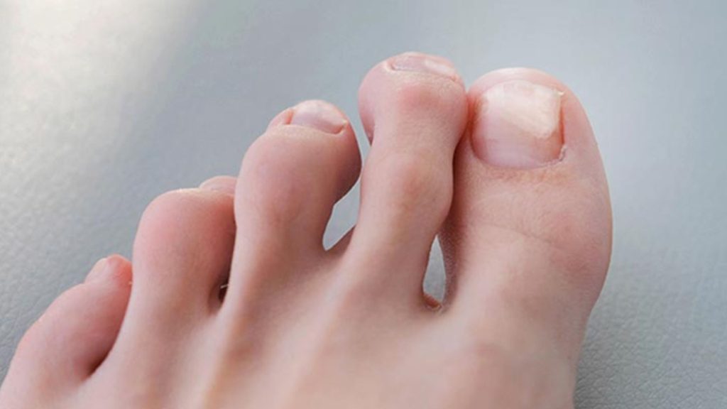 Close-up view of toes showing the shape and position of the toenails