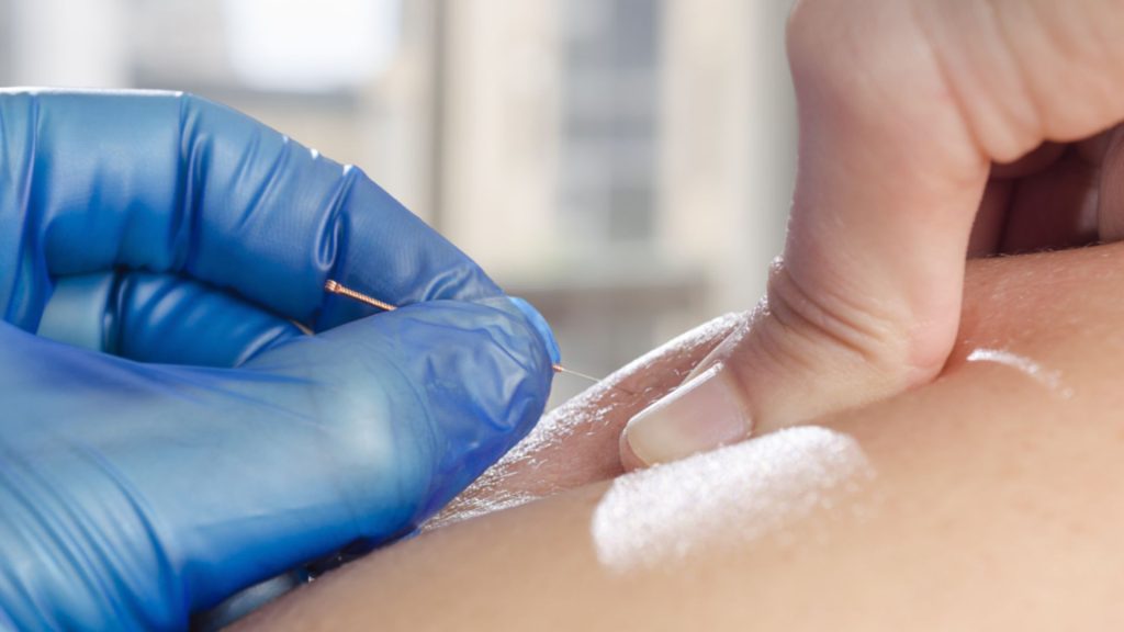 Close-up of a physiotherapist wearing blue gloves performing dry needling with a fine needle on a patient’s muscle, demonstrating anatomy-based treatment for muscle trigger points.