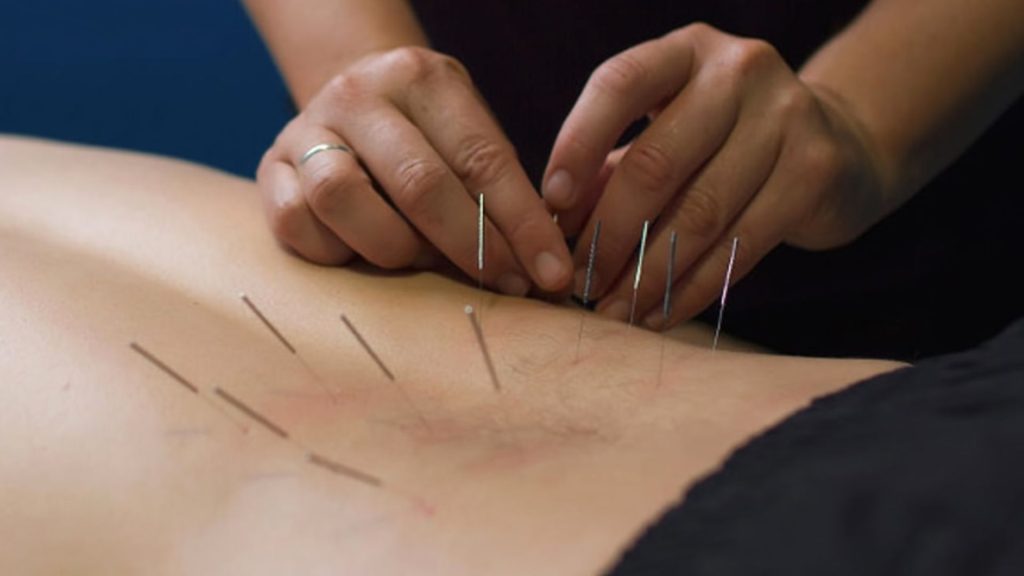 Physiotherapist performing dry needling on a patient’s back, with multiple fine needles placed into muscle trigger points as part of evidence-based pain management treatment.