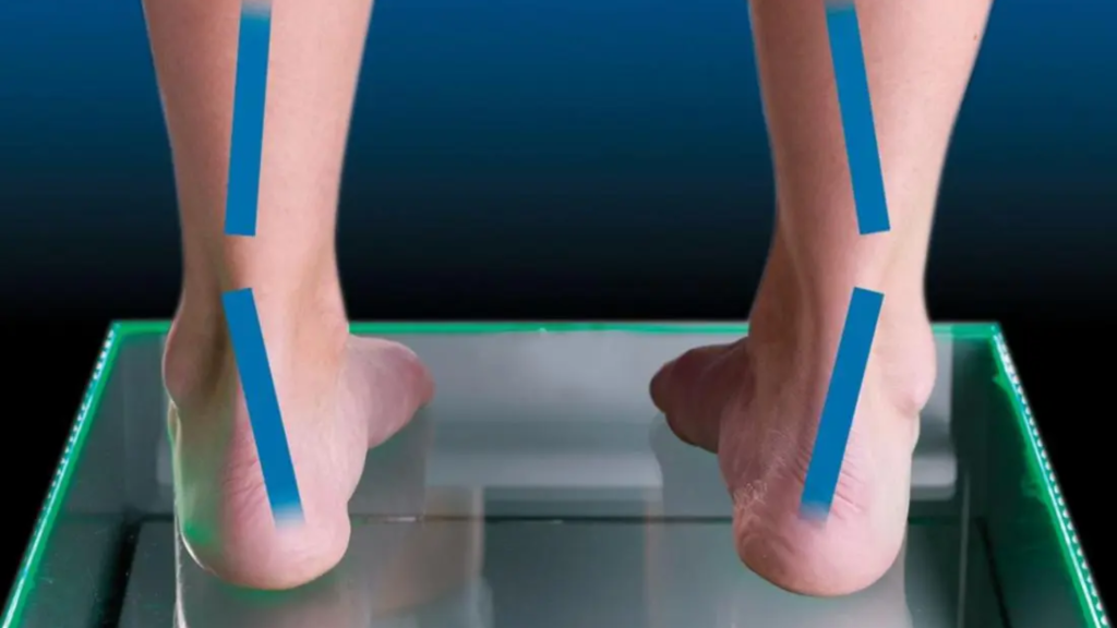 Inward heel alignment and lower limb posture, illustrating foot mechanics that can affect gait.