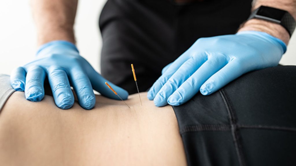 Physiotherapist wearing blue gloves performing dry needling on a patient’s thigh, with fine needles placed into muscle trigger points to address localised muscle pain and guarding.