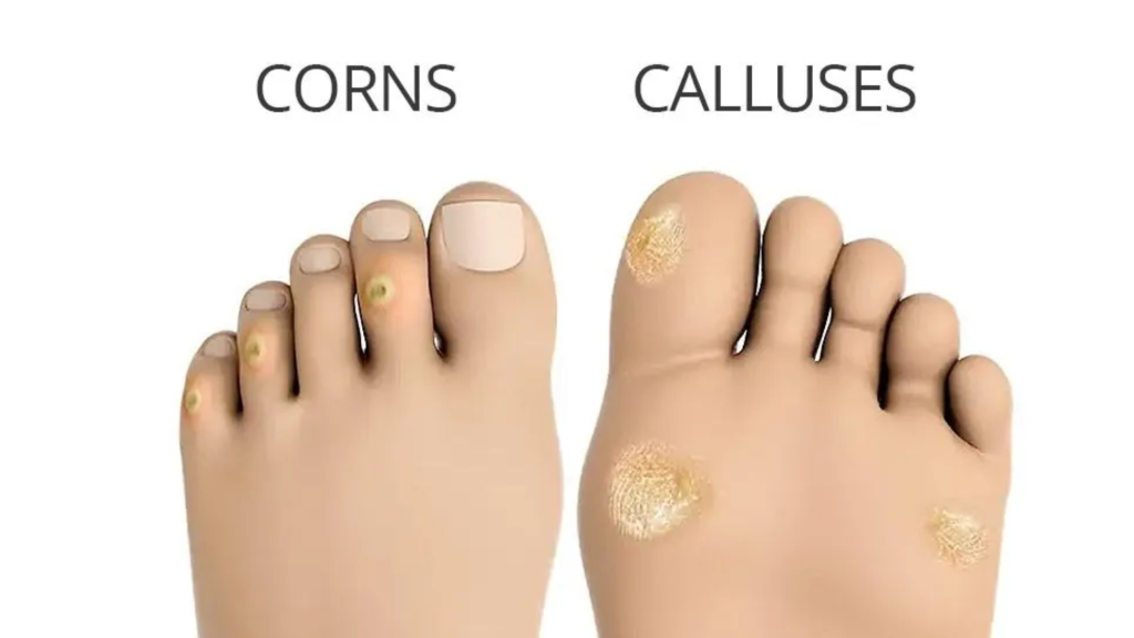 Illustration showing the difference between corns and calluses on the feet