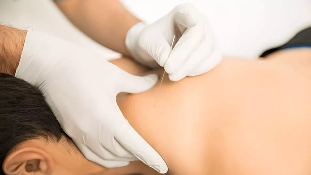 Physiotherapist wearing gloves performing dry needling on a patient’s upper back and shoulder area, targeting muscle trigger points to relieve localised muscle pain and tension.
