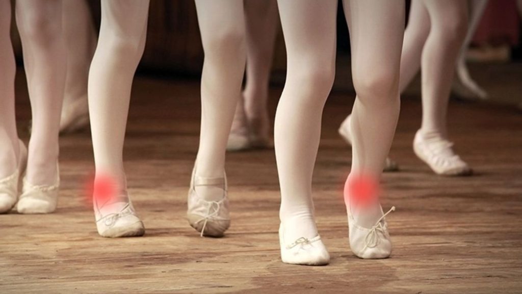 Ballet dancers standing in demi-pointe with red highlighted areas around the heels, illustrating plantar fasciitis and foot strain from repeated dance loading and fatigue.