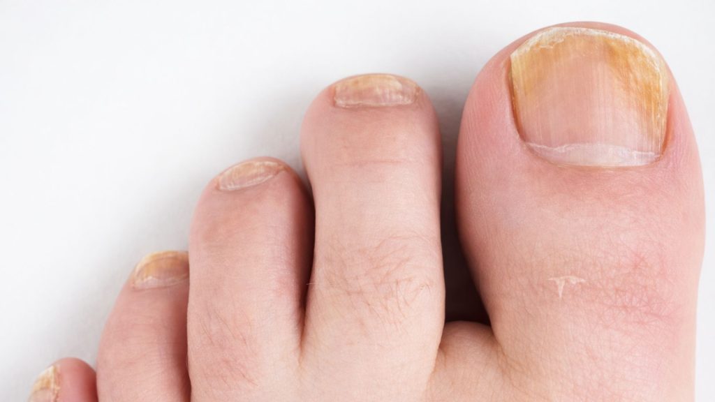 Early-stage fungal nail infection showing mild yellow discolouration and subtle thickening of the toenail.