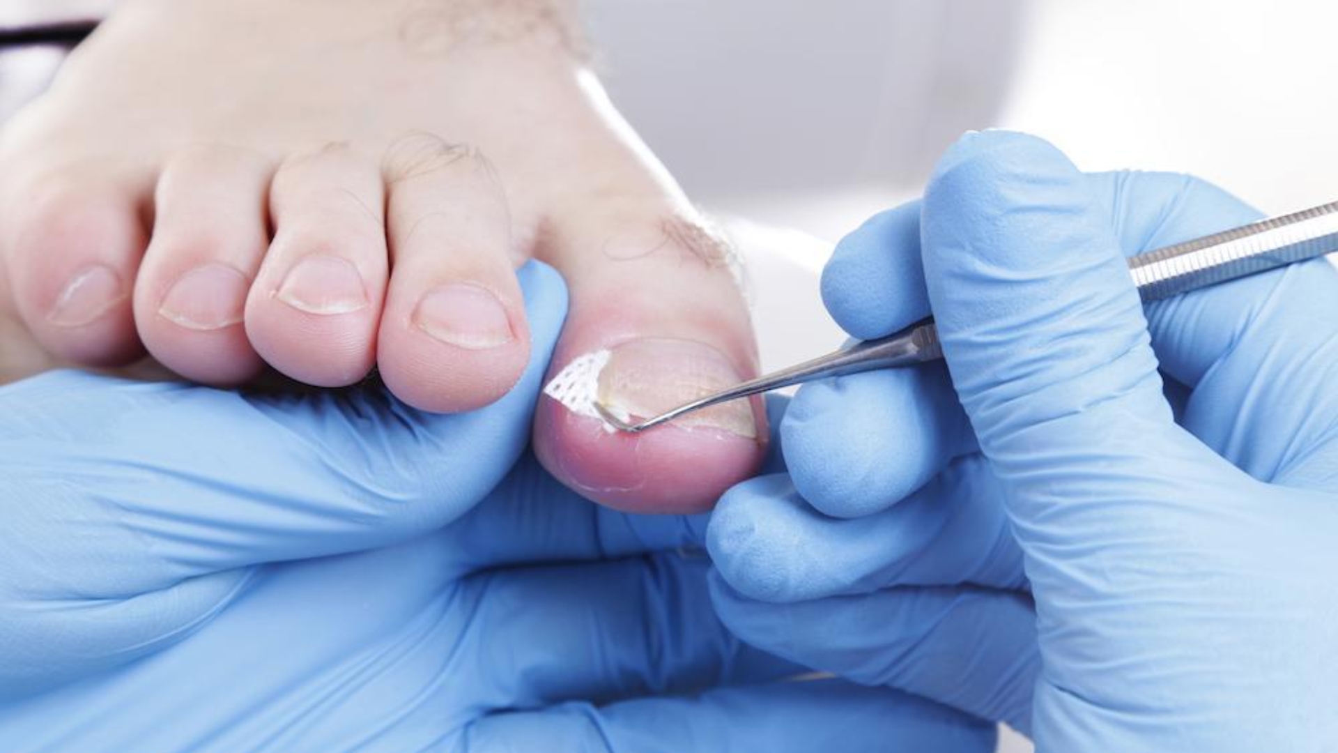Podiatrist performing professional ingrown toenail treatment using specialised instruments.