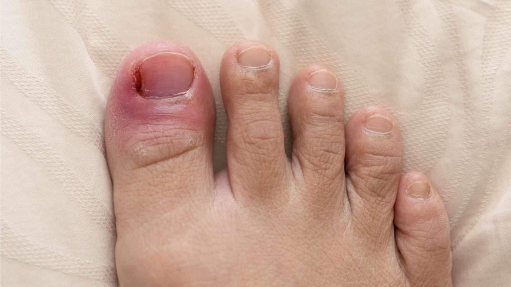 Inflamed big toe with redness and swelling caused by an untreated ingrown toenail.
