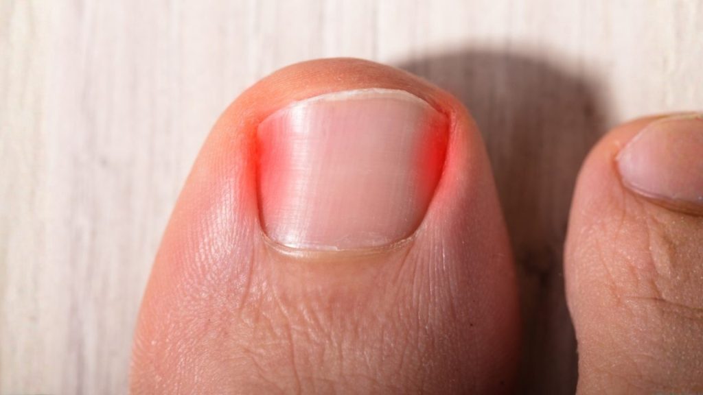 Early-stage ingrown toenail showing mild redness and tenderness around the nail edge.
