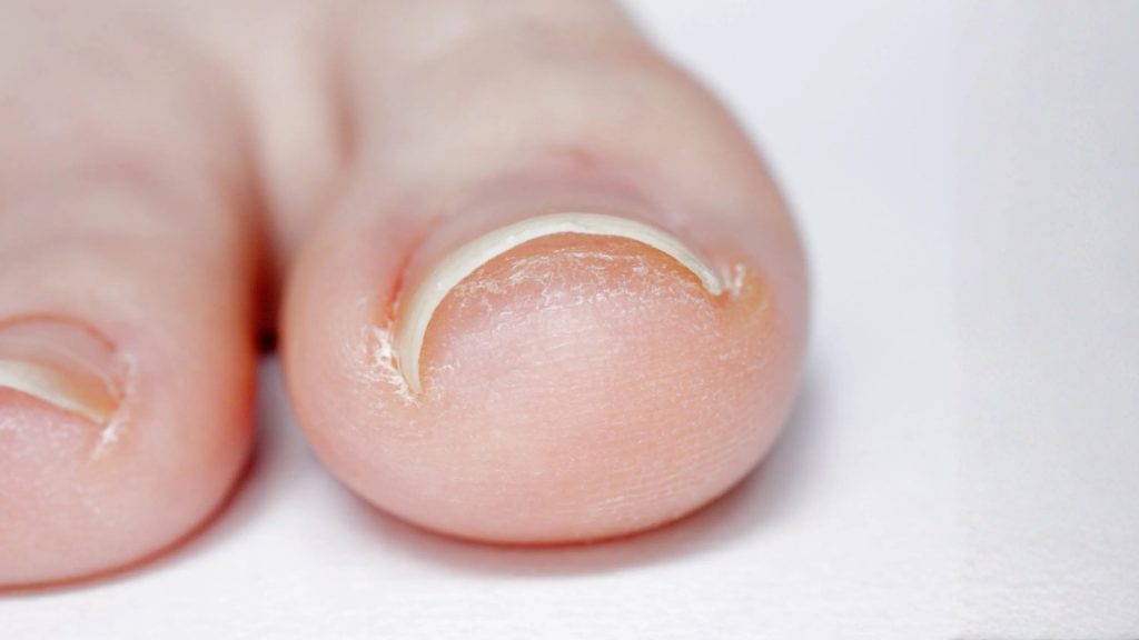 Close-up of a toenail edge pressing into surrounding skin, showing early ingrown nail changes.
