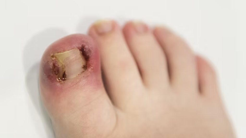 Severely infected ingrown toenail with swelling, discoloration, and tissue damage.
