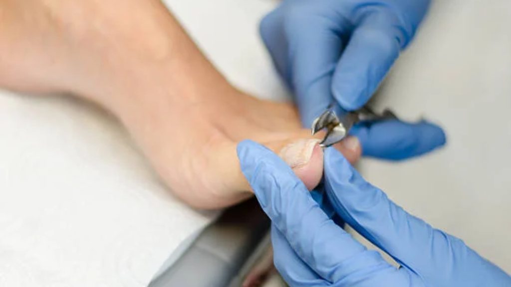 Podiatrist performing professional ingrown toenail treatment using sterile instruments.
