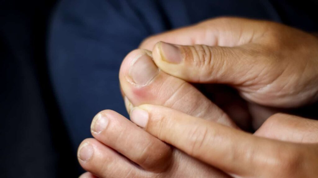 Person holding a painful big toe, indicating discomfort from an ingrown toenail.
