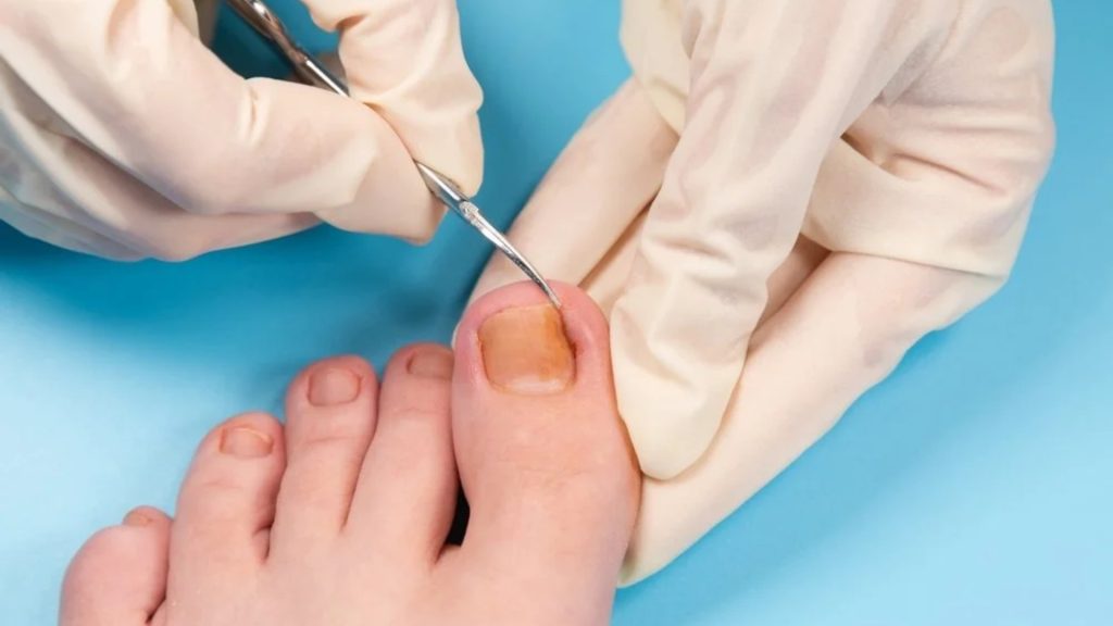 Clinician carefully treating an ingrown toenail to prevent infection and recurrence.
