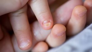 Child with yellow thickened toenail showing early signs of nail fungus in Singapore humid climate