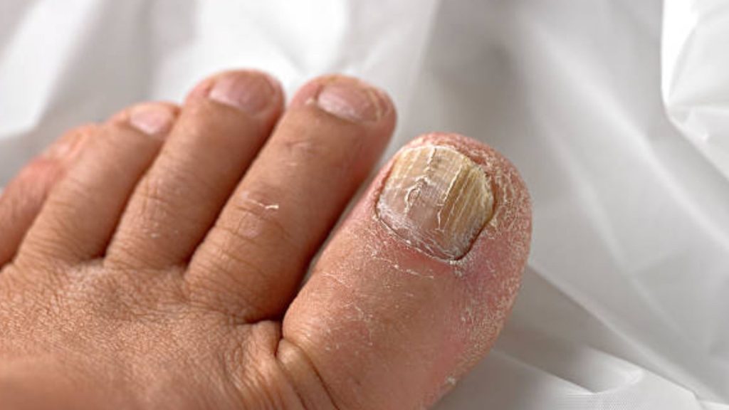 Close-up of thickened yellow toenail showing symptoms requiring nail fungus treatment in Singapore