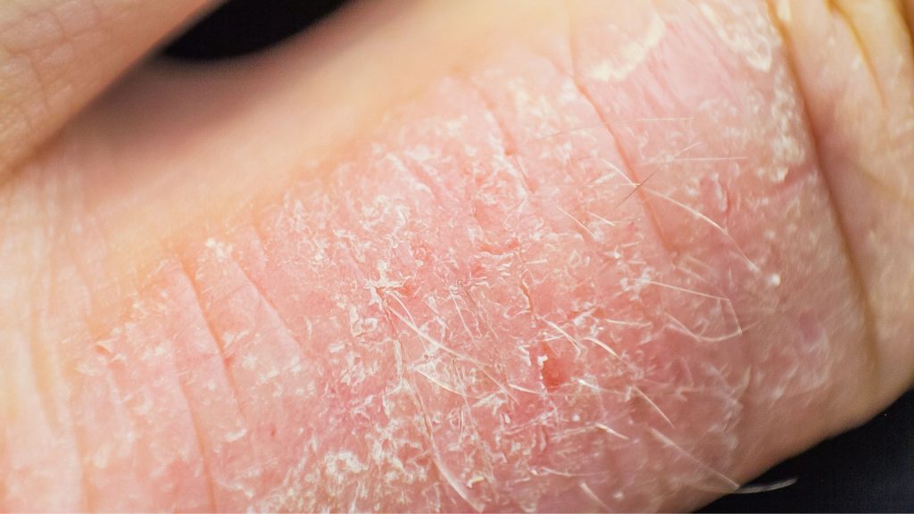 Dry flaky foot skin that may resemble fungal nail infection in children