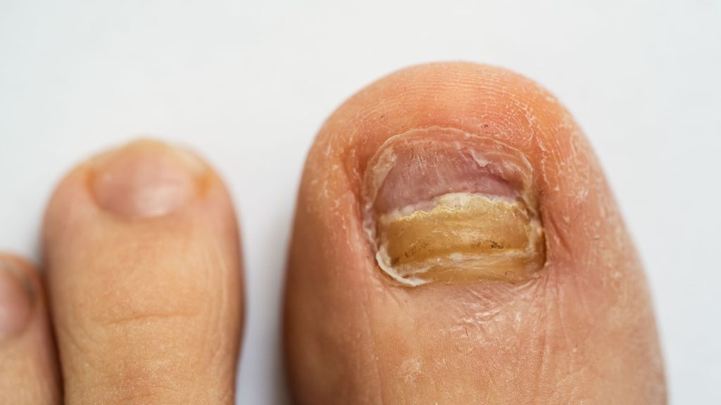Advanced thickened toenail infection needing professional nail fungus treatment in Singapore