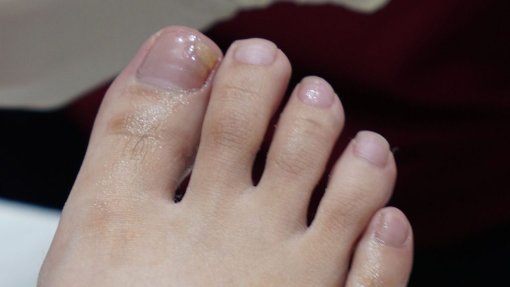Close-up of toenails showing early fungal nail infection requiring treatment in Singapore humid climate