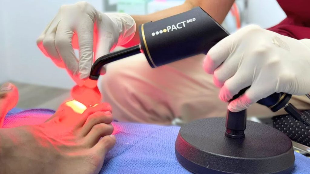 Podiatrist performing PACT light therapy for fungal nail treatment at a clinic in Singapore