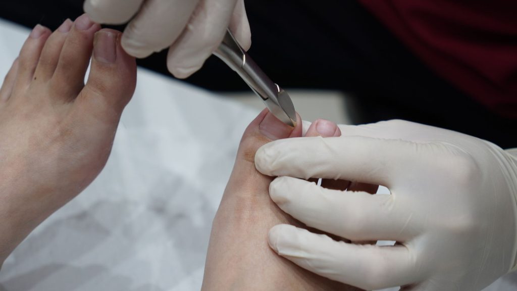Podiatrist performing nail debridement to reduce thick fungal nail infection