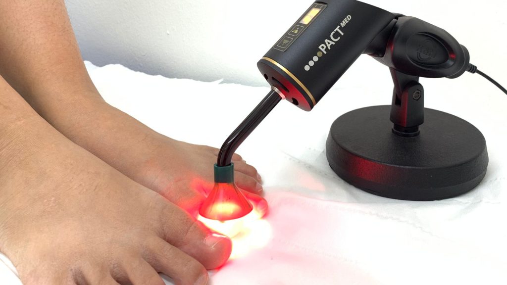 PACT photodynamic antifungal light therapy device used to treat fungal nail infection